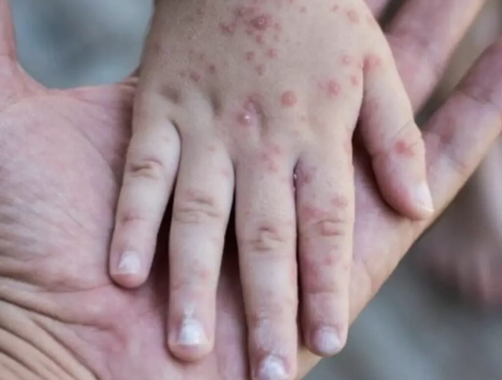 Confirma la Secretaría de Salud de Guerrero la muerte de un menor por sarampión